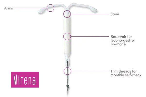 Image showing a Mirena IUD including the arms, stem and hormone reservoir